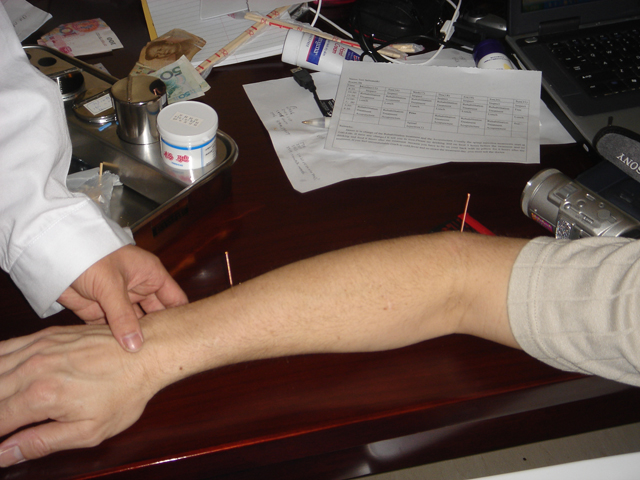 Tim gets acupuncture!! Tim gets acupuncture!!