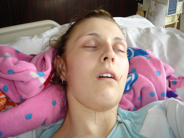 Tori's face acupuncture